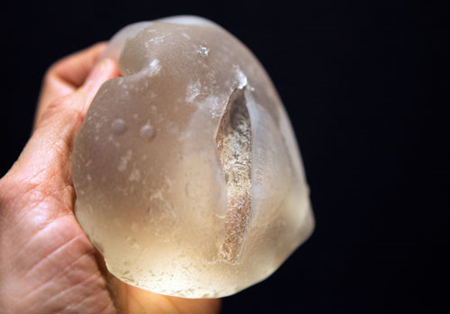 Hiểm họa ngực đẹp từ can thiệp thẩm mỹ - 4